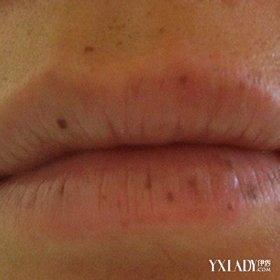 【图】嘴唇上有黑斑是什么原因？ 几个妙招教你如何预防黑斑(3)_嘴唇上有黑斑_伊秀美容网|yxlady.com