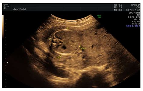 Partial Molar Pregnancy Twins