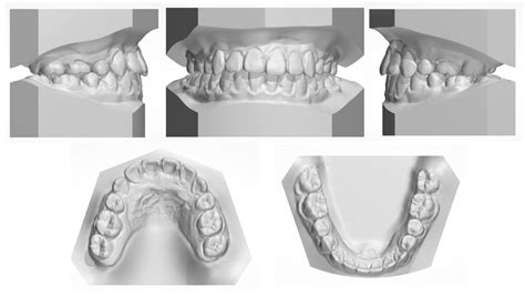 The Stability Guided Multidisciplinary Treatment of Skeletal Class III ...