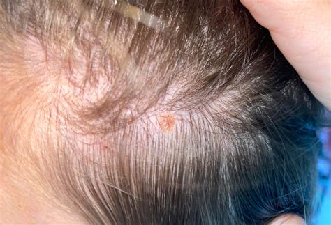 pictures of cancerous moles on scalp | Symptoms and pictures