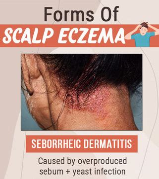 Scalp Eczema: Causes, Symptoms, Treatments & Preventive Tips – Vedix