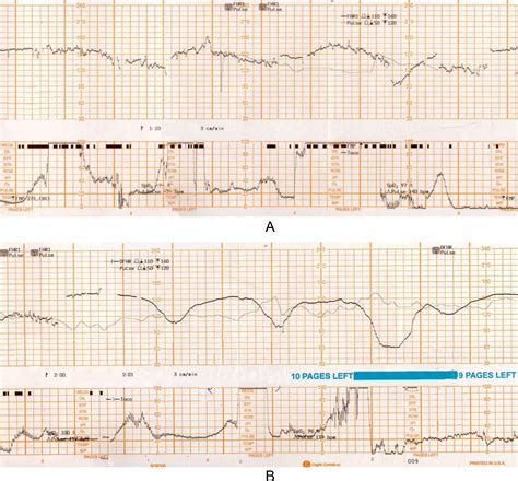 The fetal scalp electrode shortage is an urgent patient safety issue ...