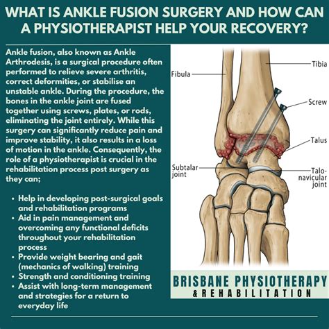 Ankle Fusion Surgery - Brisbane Physiotherapy & Podiatry