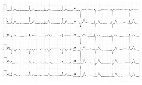 Management of Complete Heart Block in a Pregnant Woman with Systemic ...