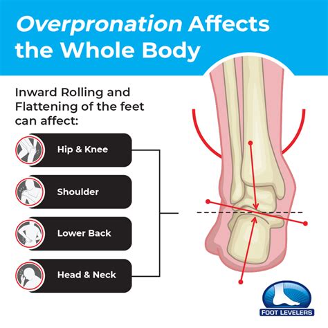 What Causes Pronation Of Foot High Arch Feet (Pes Cavus): Causes,
