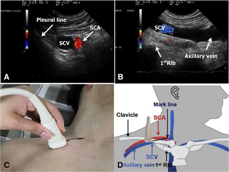 Central Venous Catheter Subclavian