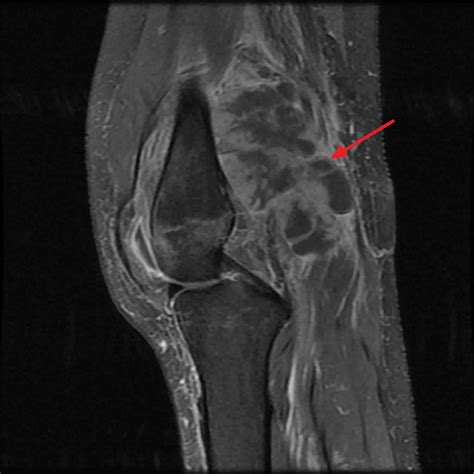 Ewing's sarcoma, causes, signs, symptoms, diagnosis, treatment & prognosis