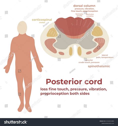 Posterior Cord Syndrome