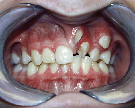 Braces Before And After Buck Teeth at Marion Akers blog