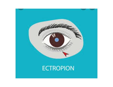 Ectropion eye disease - Bsc.optometry - Studocu