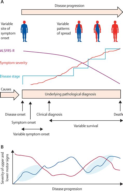 Amyotrophic lateral sclerosis: moving towards a new classification ...