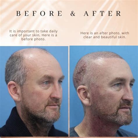 7000 Grafts Hair transplant: The Complete Guide