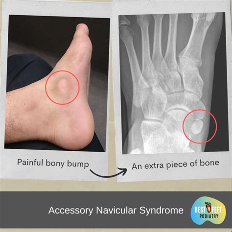 Accessory Navicular File:Acessory Navicular Bone 2.jpg Wikimedia