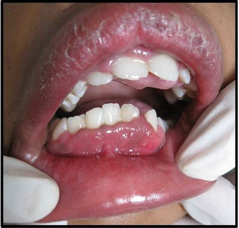 Clinicopathological significance of Melkersson-Rosenthal syndrome | BMJ Case Reports