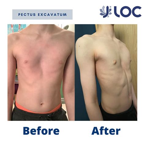 Pectus Excavatum Treatments
