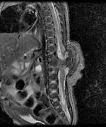 Image result for diastematomyelia
