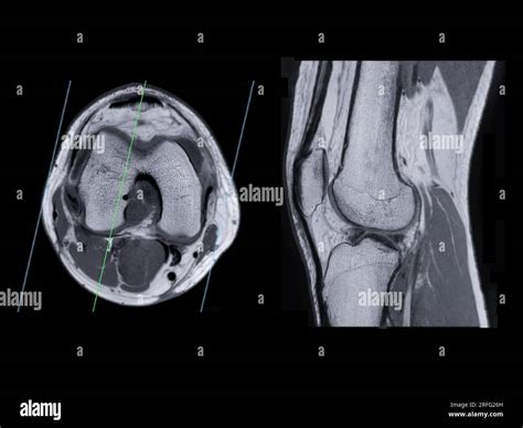 Xknee Startradiology Cruciate Ligament Radiology