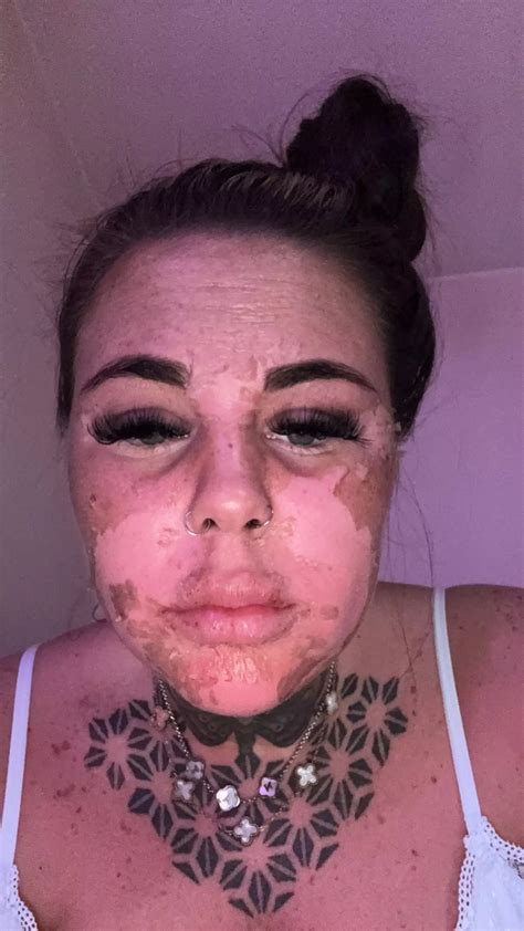 Influencer left horrified after accidentally burning skin off face ...