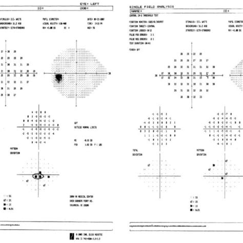 Image result for Abnormal Visual Field Testing