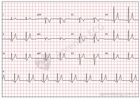 Síndrome de Brugada - Aprenda ECG | Doctor Quest