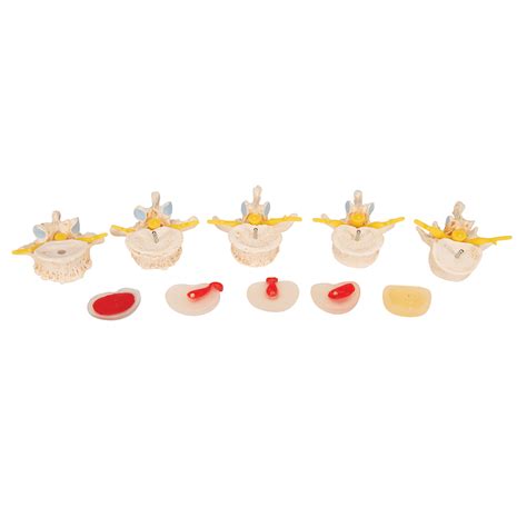 Anatomical Teaching Models - Plastic Vertebrae Model - Disc Prolapse Model