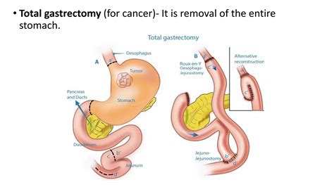 Image result for Colon Polyps Types
