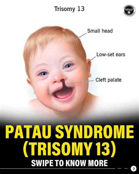 Sindrome De Patau Patau Syndrome Trisomy 13 Archives