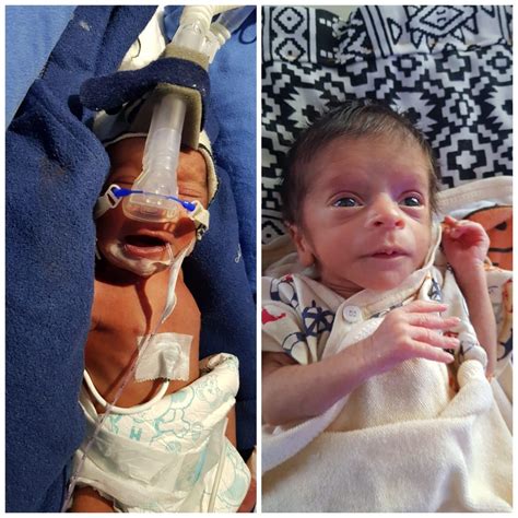 Premature Baby 30 Weken Overleving Overlevingskans Van Prematuren En