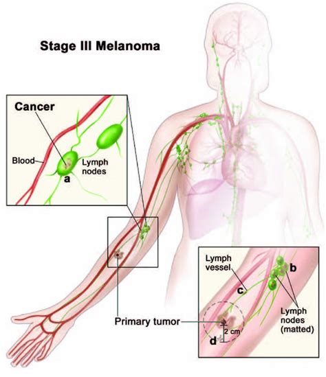 Melanoma, causes, signs, symptoms, diagnosis, treatment & prognosis