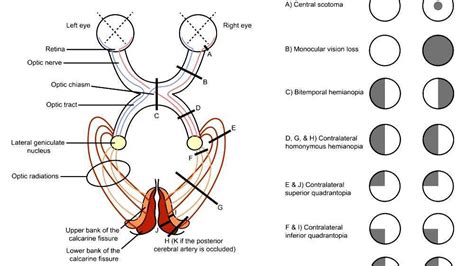 Image result for Contralateral Homonymous Hemianopsia