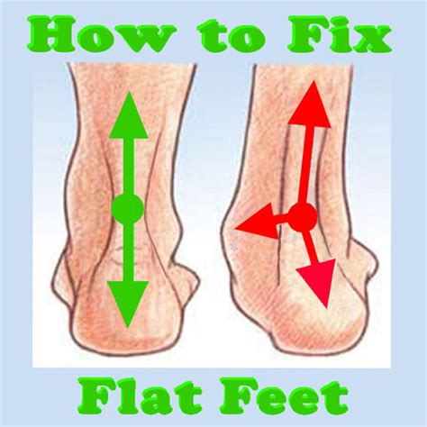 How To Fix Flat Feet