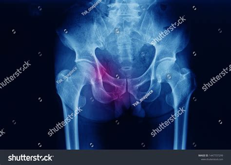 2,128 Pelvic fracture 이미지, 스톡 사진 및 벡터 | Shutterstock