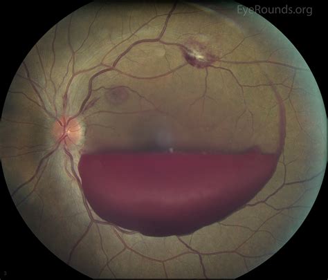 Vitreous Hemorrhage Icd 10 Diabetic Retinopathy Treatment | European