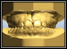 Image result for How to Take Study Models with Plaster Lab