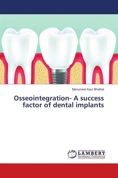 Osseointegration- A success factor of dental implants : Amazon.in: Books