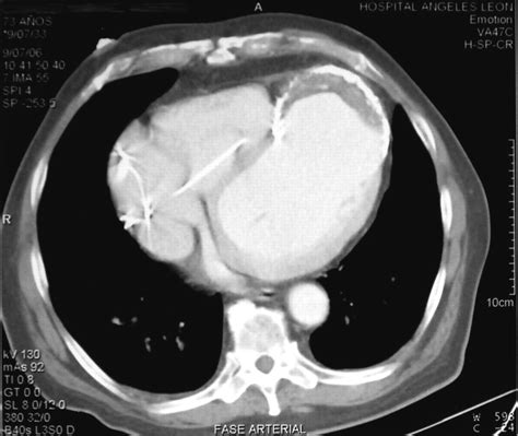A Ring in the Heart Calcified Left Ventricular Aneurysm | Circulation