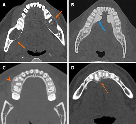 Imaging approach for jaw and maxillofacial bone tumors with updates ...