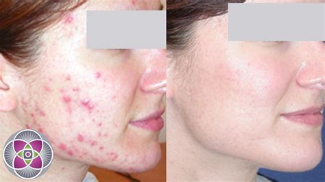 Laser acne treatment – Artofit