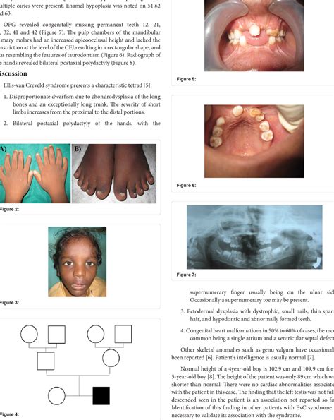 Ellis Van Creveld Syndrome Symptoms