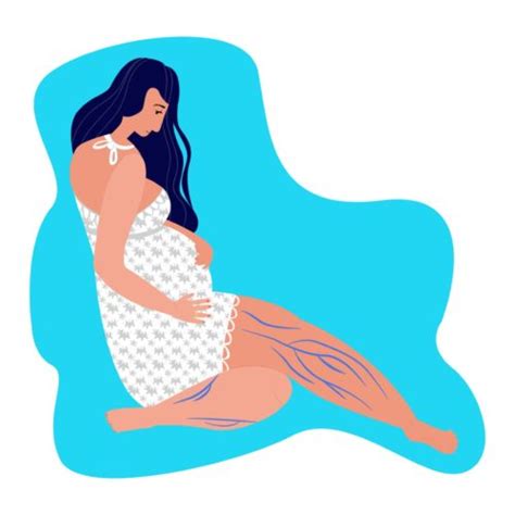 How to get rid of Varicose Veins In Pregnancy | Motherhood Hospitals Blog