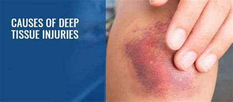 Image result for Deep Tissue Injuries