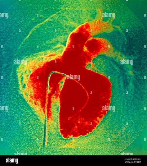 Congenital heart disease (hole in the heart). Angiogram of a ventricular septal defect. This is ...