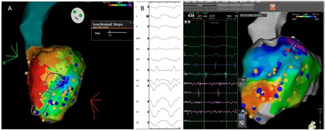 Ventricular Tachycardia Ablation Guided by Functional Substrate Mapping ...