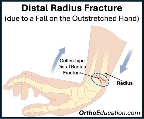 Distal Radius Fractures - Hand Education