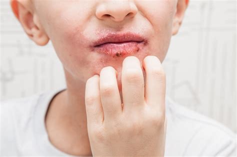 7 Tips to prevent rashes on lips – mars by GHC