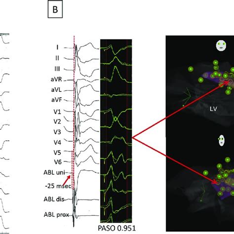 Image result for PVC Localization