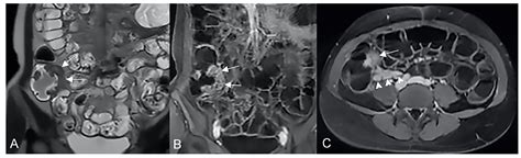 Small Bowel Imaging from Stepchild of Roentgenology to MR Enterography ...