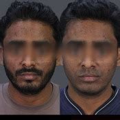 Pigmentation Treatment in Delhi