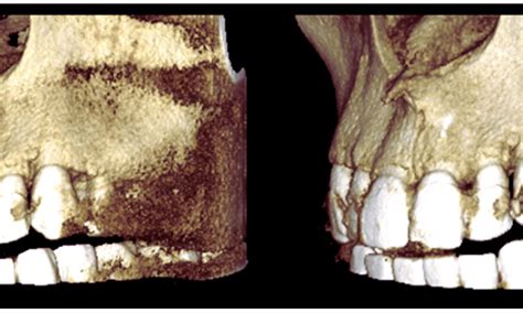 Case Report Highlights Complete Healing of Apical Fenestration with Non ...