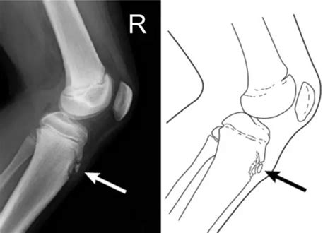 胫骨粗隆 的图像结果